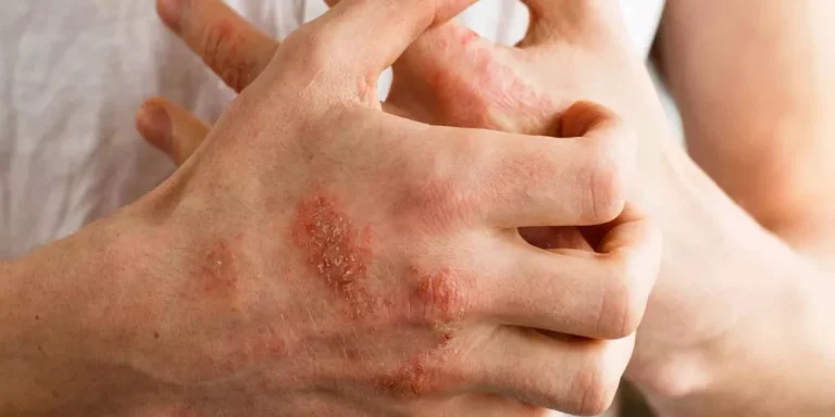 بعد تحذير وزارة الصحة السعودية منه.. هذه أعراض مرض «الإكزيما» وطرق علاجه