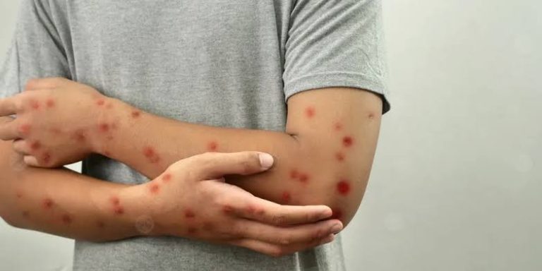 رصد أول إصابة بالسلالة الأكثر خطورة من جدري القرود في كندا.. وتحذيرات من السفر لإفريقيا
