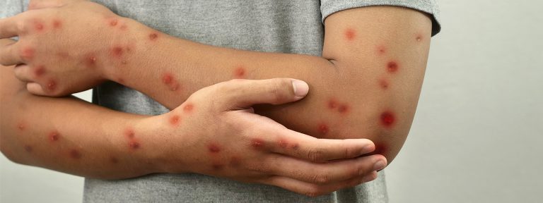أستراليا تسجل أول حالة إصابة بسلالة “mpox” الأشد خطورة.. تعرف على أعراض المرض وسبل الوقاية
